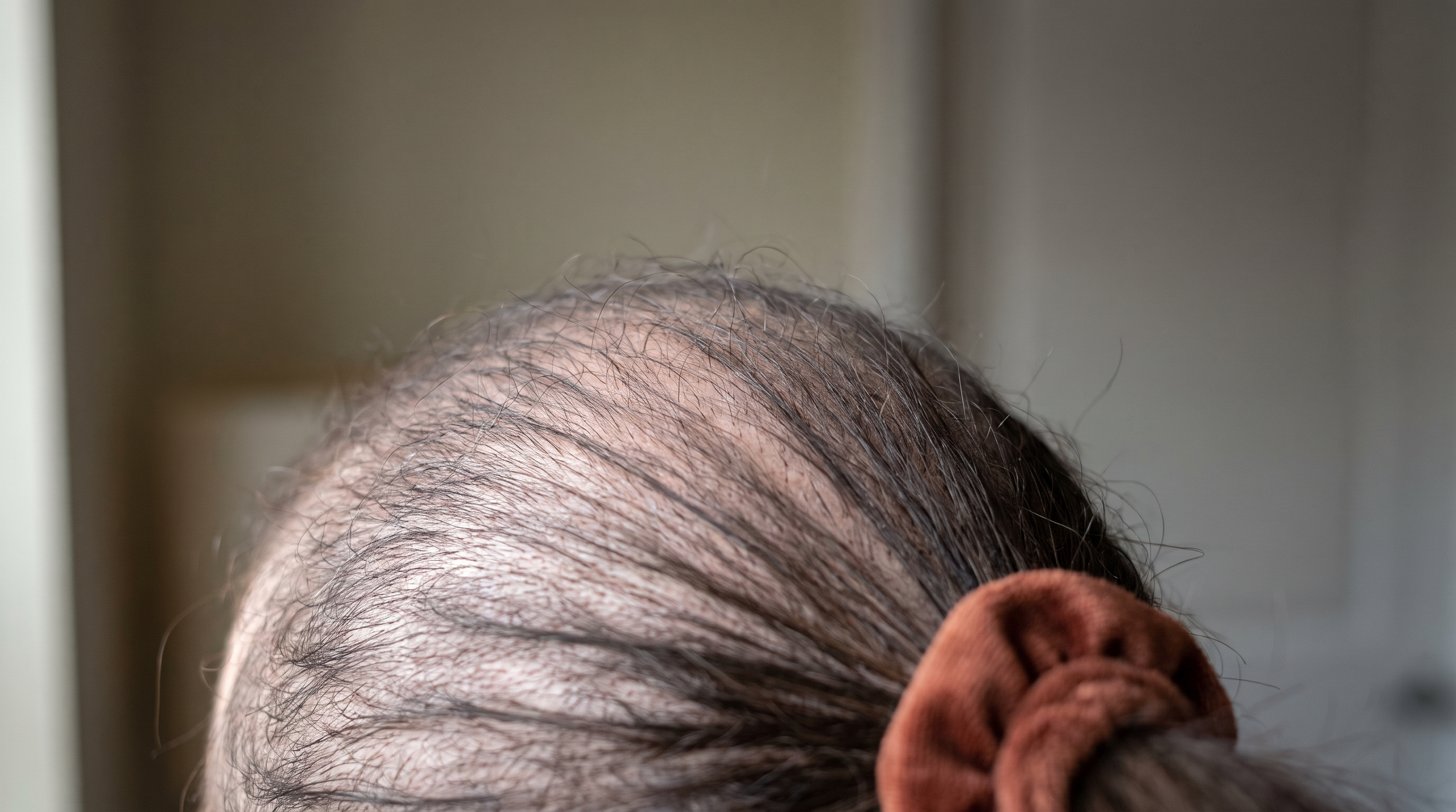 Close-up of a person's scalp showing hair loss